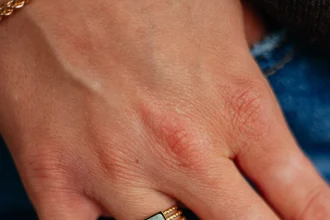 Adelia Ring
